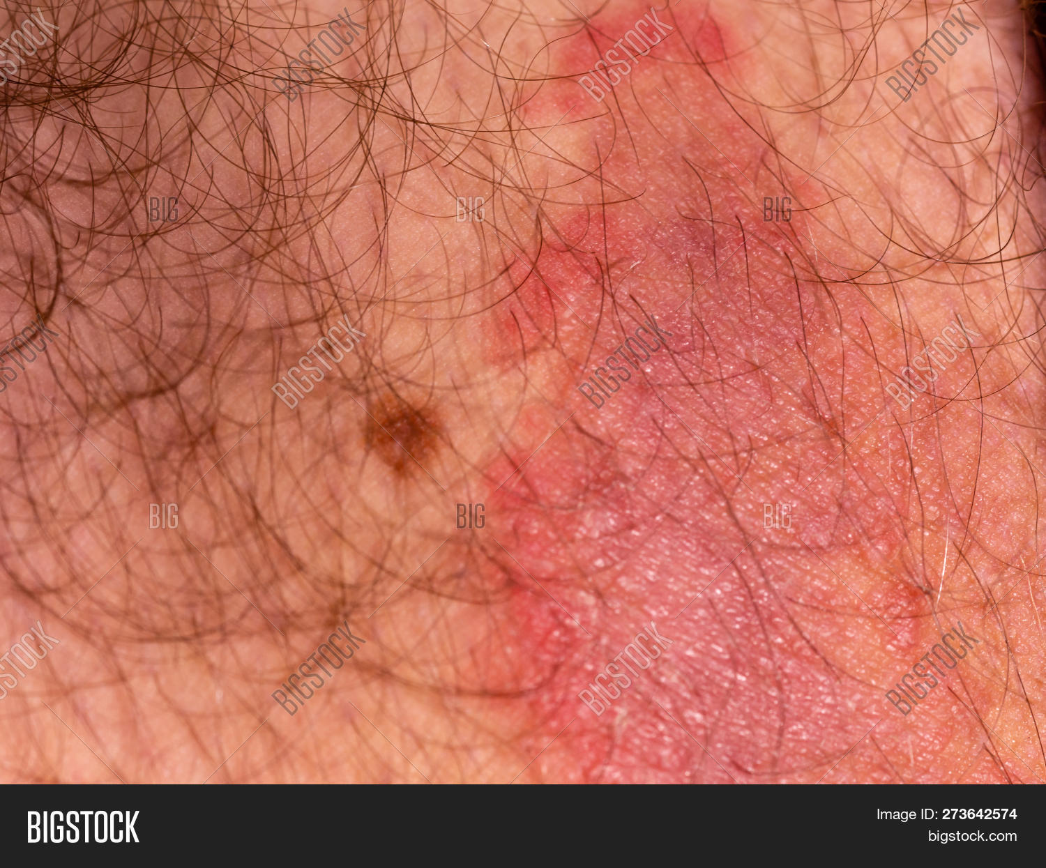 Macro,atopic,body,care,closeup,condition,dermatitis,dermatology,disease,dry,fungal,fungi,fungus,health,human,illness,infection,leg,medical,medicine,mycosis,pain,painful,psoriasis,rash,red,ringworm,skin,white
