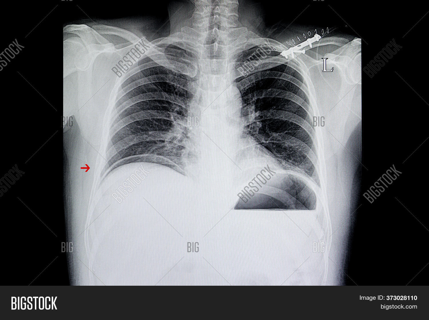 xray, 																					film, 																					chest, 																					pulmonary, 																					scan, 																					patient, 																					abdomen, 																					diagnosis, 																					ray, 																					x, 																					background, 																					human, 																					image, 																					medicine, 																					medical, 																					traumatic, 																					accident, 																					fracture, 																					clavicle, 																					surgery, 																					contrast, 																					x-ray, 																					white, 																					body, 																					ruptured, 																					hollow, 																					abdominal, 																					organs, 																					hospital, 																					anatomy, 																					bone, 																					skeleton, 																					sickness, 																					sick, 																					radiology, 																					thorax, 																					thoracic, 																					emergency, 																					urgency, 																					operation, 																					sepsis, 																					peritonitis