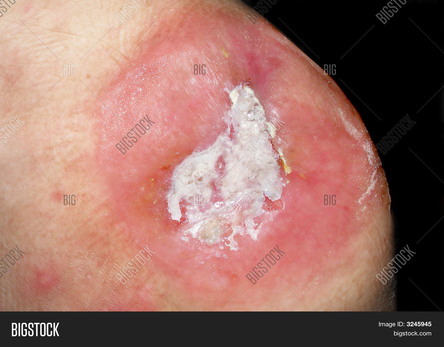abscess,allergic,bone,burn,cauterize,deep,disease,dry,erythema,granulating,granulation,healing,health,ill,illness,infected,infection,inflammation,left,nitrate,open,operation,painful,procedure,reaction,red,shoulder,sick,silver,surgery,surgical,tissue,treatment,white,wound.