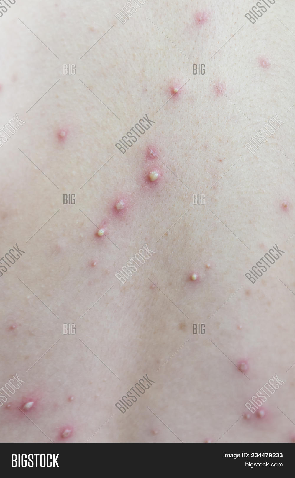 acne,baby,back,background,body,care,chicken,chickenpox,child,closeup,detail,girl,health,healthcare,illness,infection,itch,pox,rash,reaction,red,scratch,sick,sickness,skin,symptoms,virus,woman