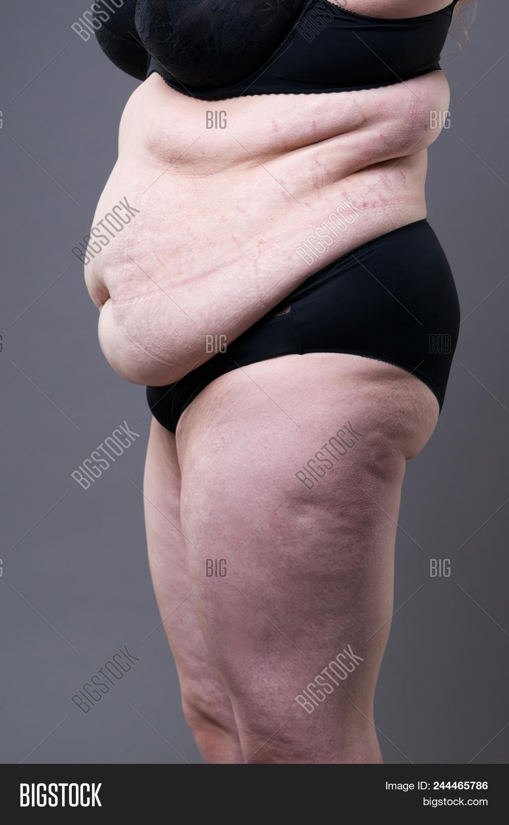 abdomen,abdominal,adipose,adiposity,bad,belly,big,body,breast,cellulite,cellulitis,diet,dieting,excess,fat,fatty,female,flab,flabby,fold,fulness,gain,growth,hip,large,lingerie,liposuction,loss,marks,medicines,obese,obeseness,obesity,oversized,overweight,shape,skin,slimming,stomach,stretch,surgery,thick,thighs,tuck,tummy,underwear,unhealthy,waist,weight,woman