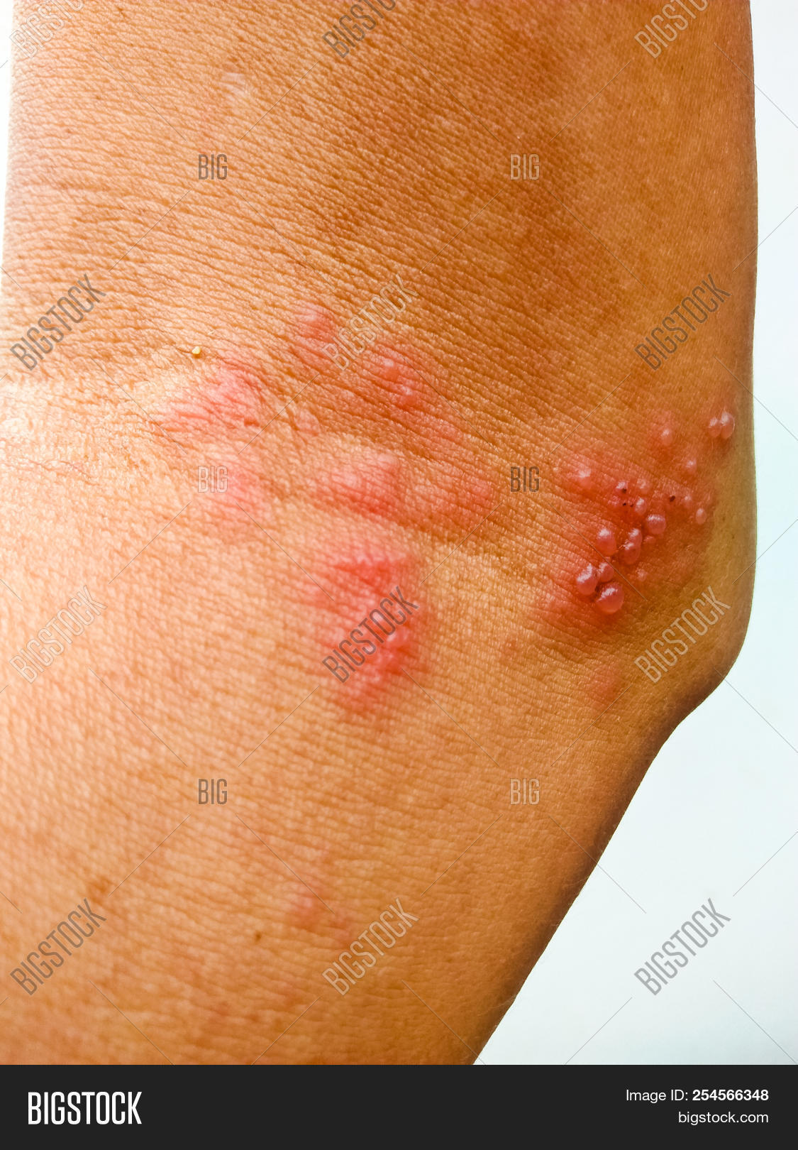 allergic,dermatology,disease,epidermis,health,herpes,illness,infection,irritated,itchy,medical,plague,raised,rash,reaction,red,scratch,shingles,sick,sickness,skin,treat,viral,virus,zoster