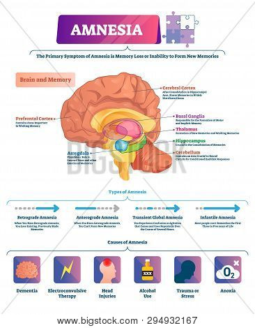 Amnesia Vector Illustration. Labeled Brain Memory Loss Disease Types ...