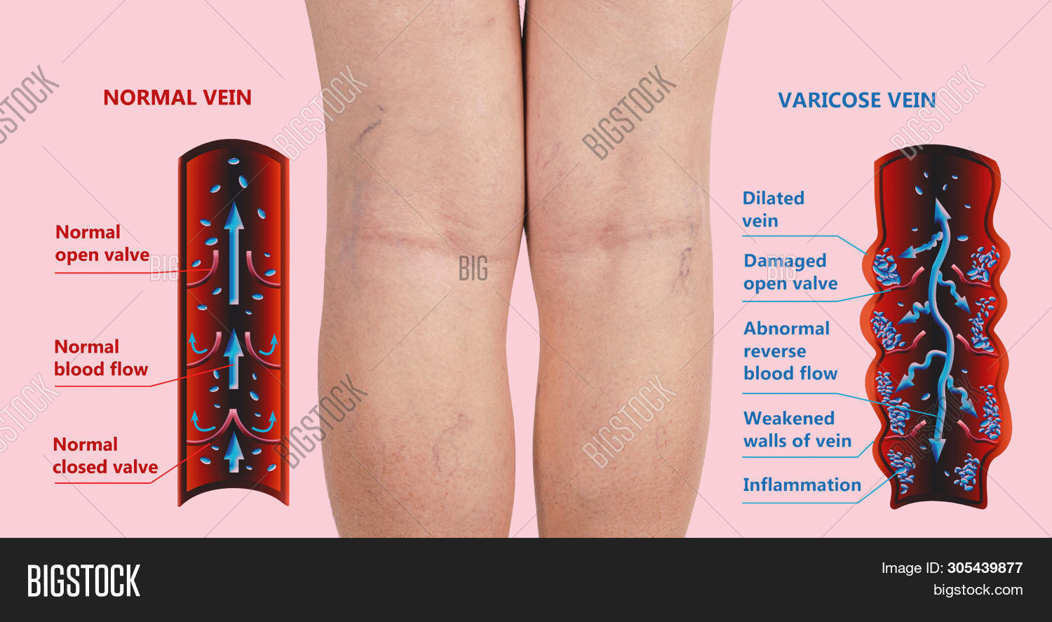 Varicose Vein On A Female Senior Legs. The Structure Of Normal And ...