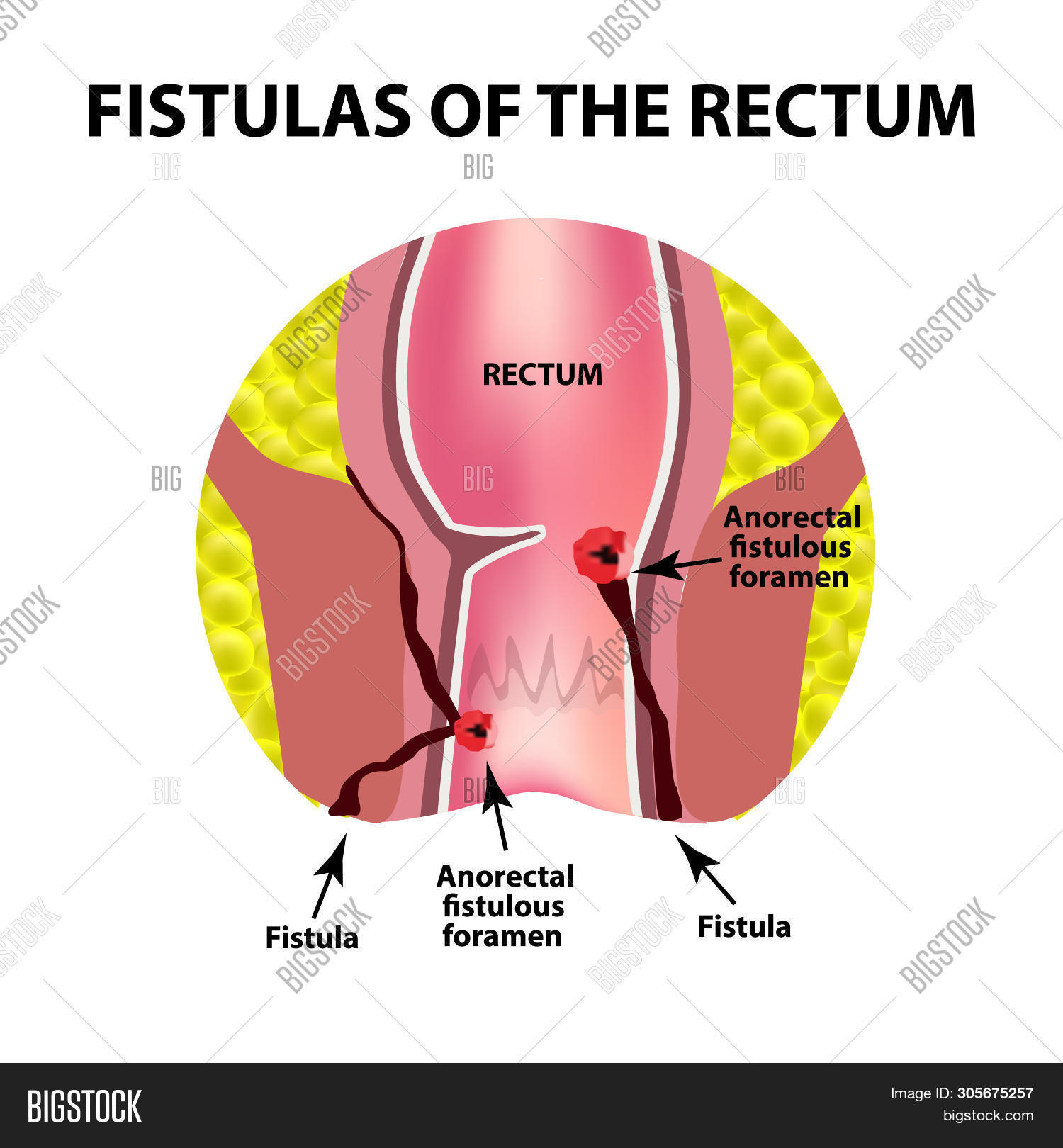 Types Of Fistulas Of The Rectum. Paraproctitis. Anus. Abscess Of The ...
