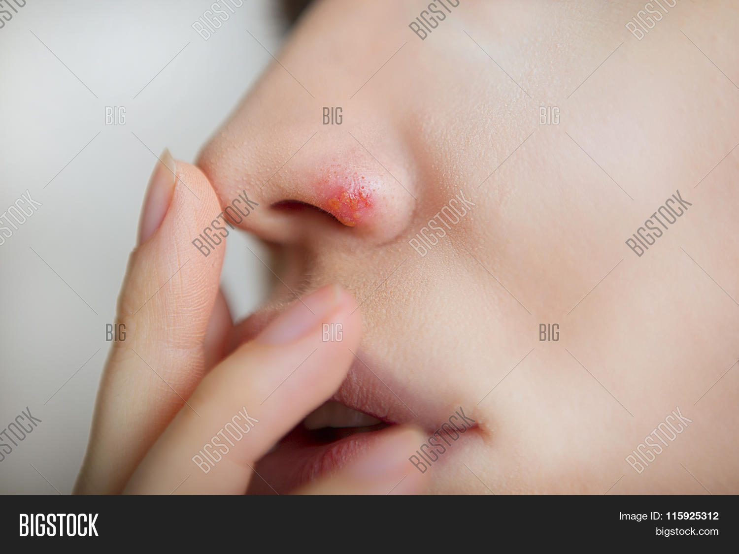 affected,blister,burned,caucasian,chapped,closeup,cold,complaint,condition,crusted,dermatology,disease,disgusting,face,fever,genetic,girl,gross,health,herpes,herpis,human,illness,infection,labialis,lips,little,macro,medical,mouth,nasal,painful,problem,scabbing,scabs,simplex,skin,sore,stubble,suffering,sun,sunburn,swollen,teen,treatment,virus,woman.,youth