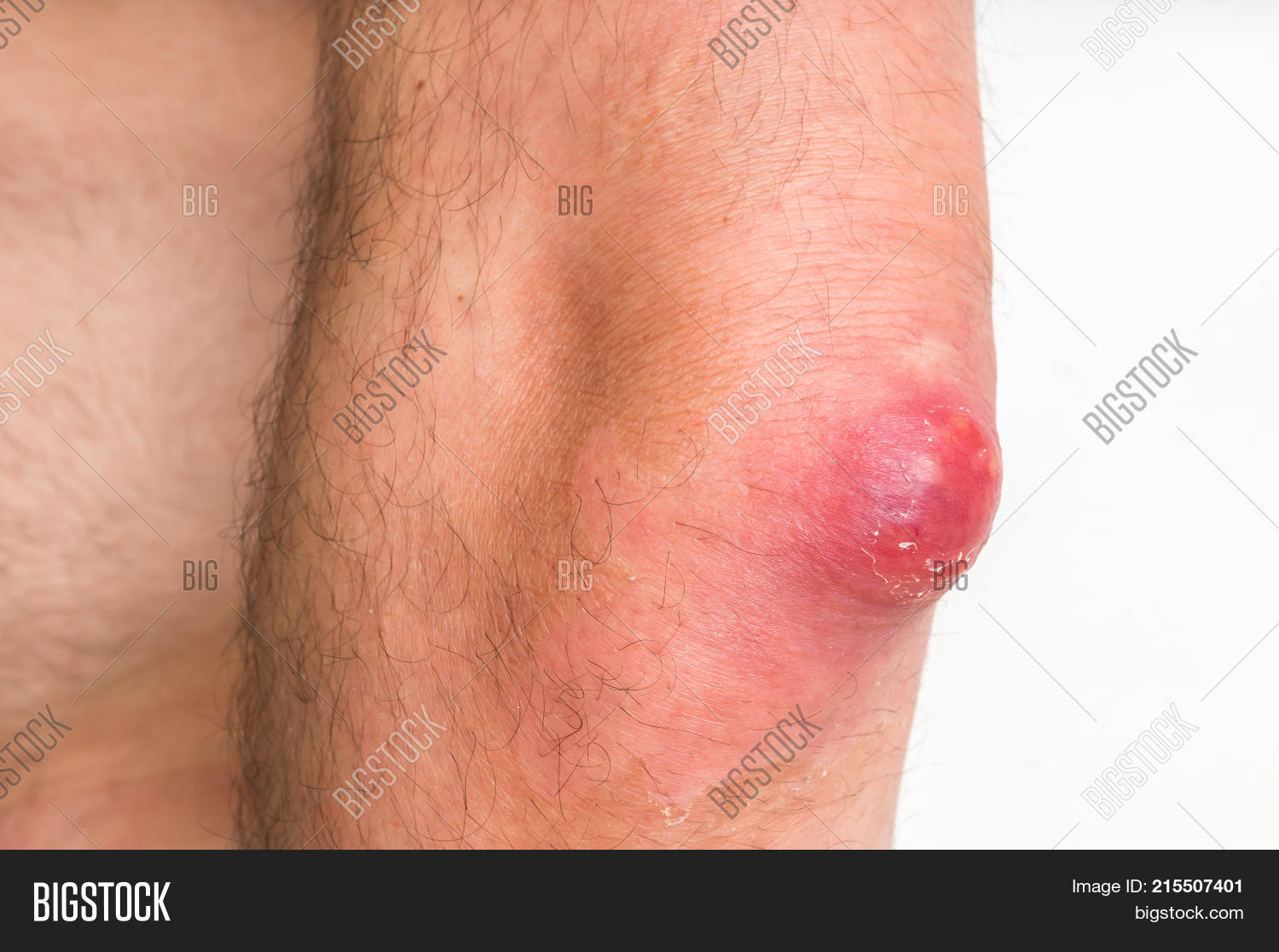 abscess,acne,arm,big,blemish,blister,boil,bump,carbuncle,care,caucasian,closeup,disease,elbow,excrescence,explode,furuncle,furunculus,hand,health,huge,infection,inflammation,lump,macro,male,man,medical,papula,papule,pimple,problem,pus,pustule,shocked,skin,surgery,teenage,teenager,whitehead,wound,zit