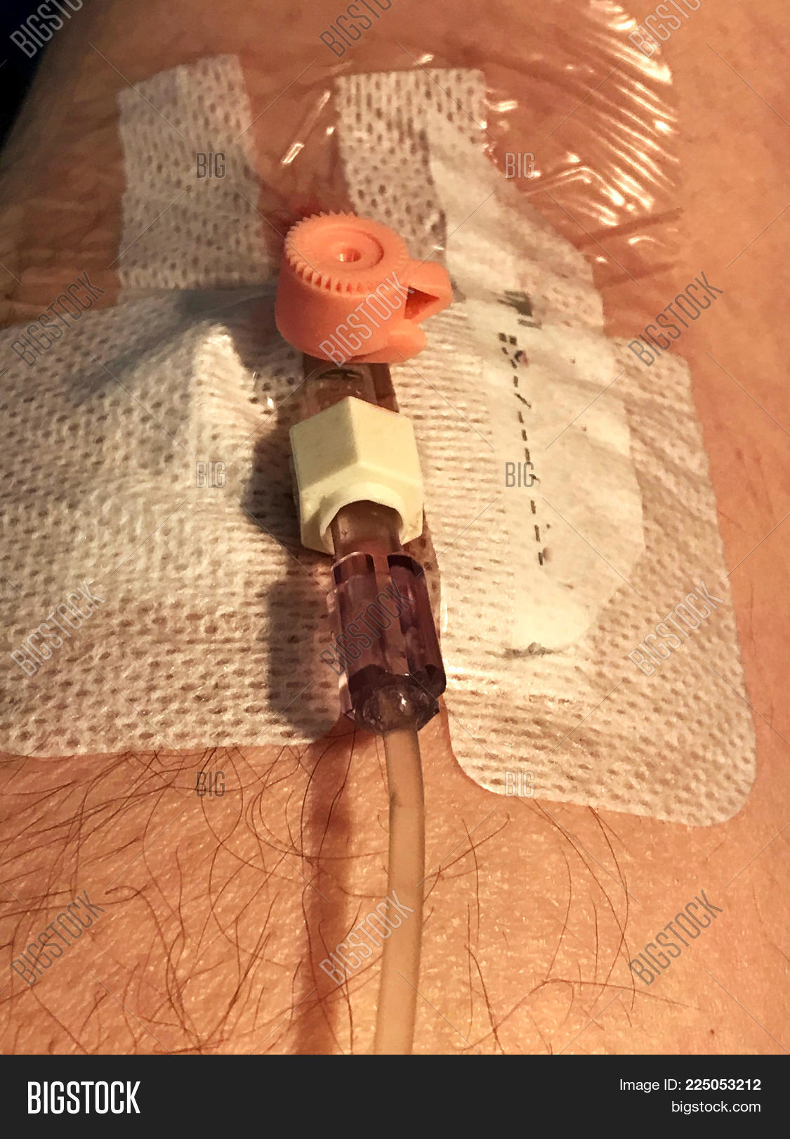 arm,attached,background,cannula,care,catheter,caucasian,clinic,close,close-up,closeup,drip,emergency,equipment,hair,hairy,hand,health,healthcare,hospital,human,illness,injection,inside,intravenous,iv,male,man,medical,medicine,needle,nursing,patient,peripheral,person,plaster,skin,tape,test,therapy,treatment,tube,up,vein,venous,white