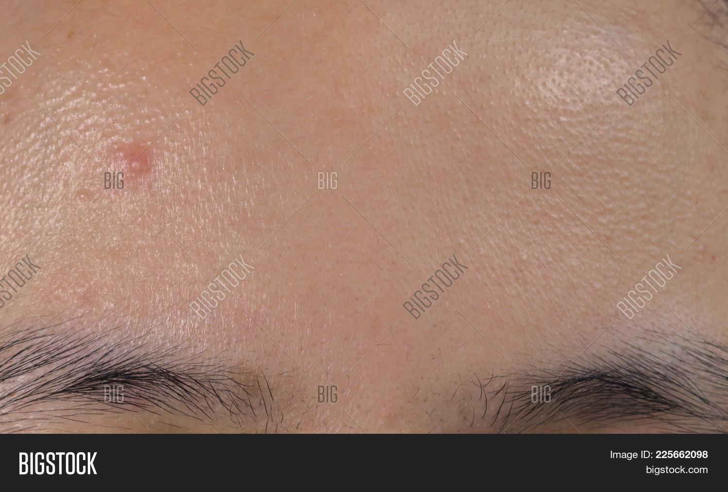 abscess,acne,adolescence,asian,background,beautiful,beauty,blemish,blister,bump,care,closeup,comedones,concept,dermatology,eyebrow,face,facial,forehead,health,healthy,hygiene,infection,inflammation,laser,lump,macro,medical,medicine,oily,papules,people,pimples,pores,problem,pustule,removal,sebum,skin,small,teenager,treatment,white,whiteheads,woman,young,zit