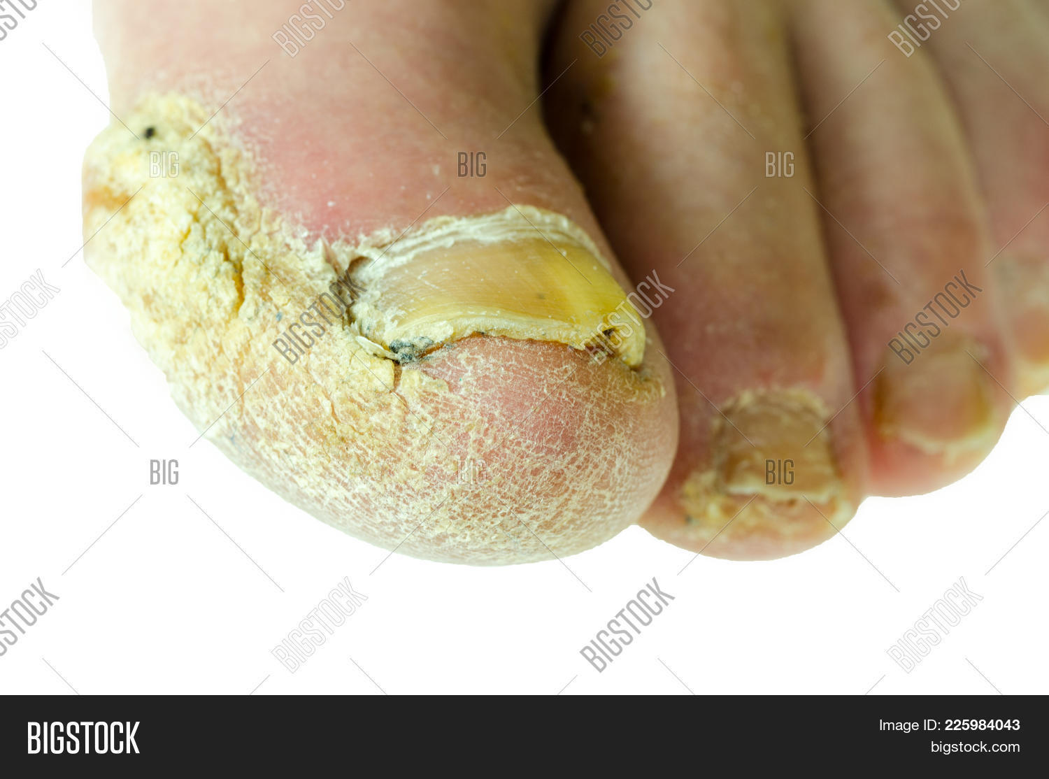 amorolfine,background,bacteria,bacterial,bad,candida,chiropody,ciclopirox,closeup,crack,damage,deformed,dermatophytes,dirty,discomfort,disease,dry,extreme,extremely,feet,finger,foot,fungal,fungi,fungus,health,healthcare,hurt,infected,infection,injured,injury,isolated,itch,macro,medical,medicine,nail,pain,painful,pedicure,pedologist,podiatrist,podiatry,skin,tinea,toe,trichophyton,walk,white