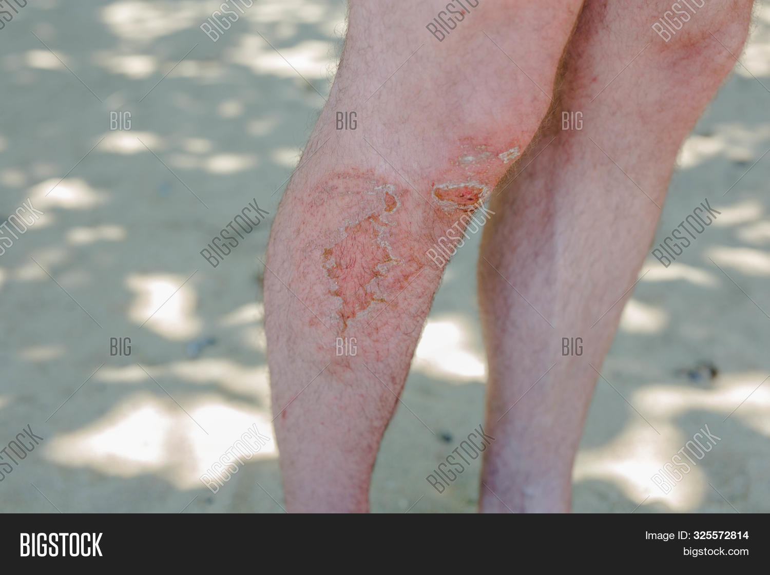 abrasions,accident,adult,aid,amputation,background,bandage,bark,berlin,blood,body,bruise,burn,care,closeup,europe,foot,germany,graze,grazing,grown,hand,health,hospital,human,hurt,infection,injured,injury,knee,leg,male,man,medical,medicine,open,outdoors,pain,patient,people,person,red,skin,sports,trauma,treatment,white,wound