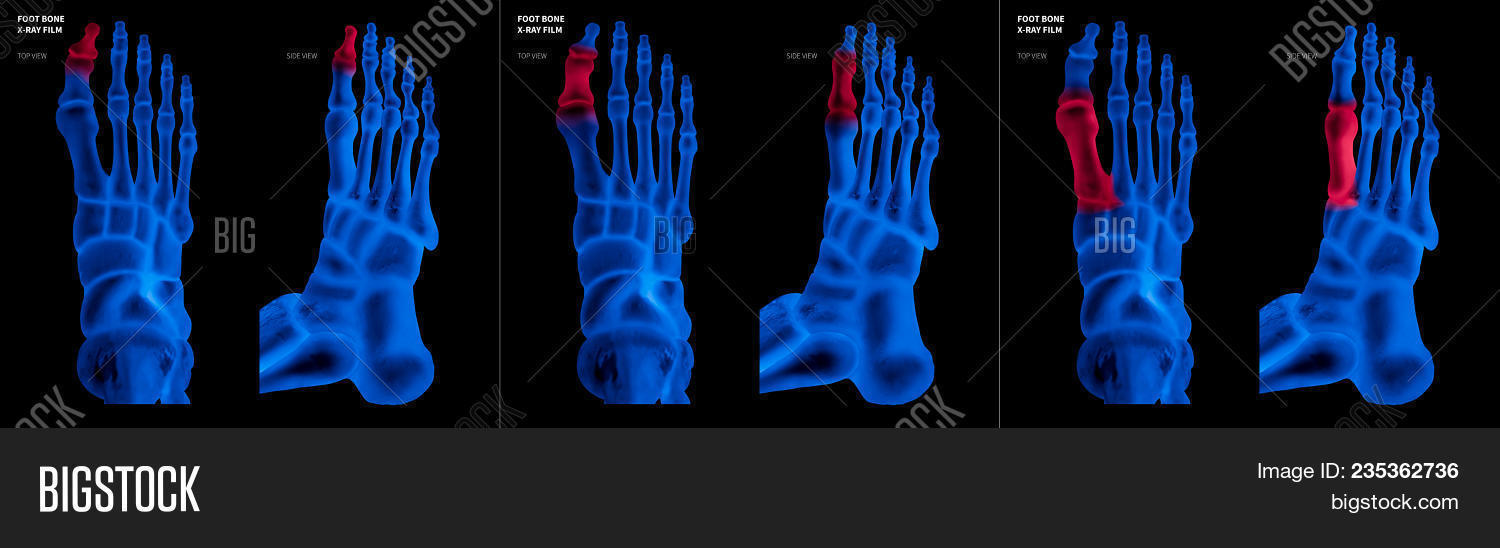 Science,accident,anatomical,anatomy,arthritis,big,bone,bony,broken,care,checkup,degeneration,diagnosis,disease,distal,film,foot,forefoot,fracture,hallux,health,hospital,human,hurt,illness,injury,joint,laboratory,long,medical,metatarsal,metatarsus,orthopedic,pain,patient,phalanges,radiography,rheumatism,rheumatoid,roentgenography,surgery,swollen,symbol,synovial,technology,toe,trauma,valgus,xray
