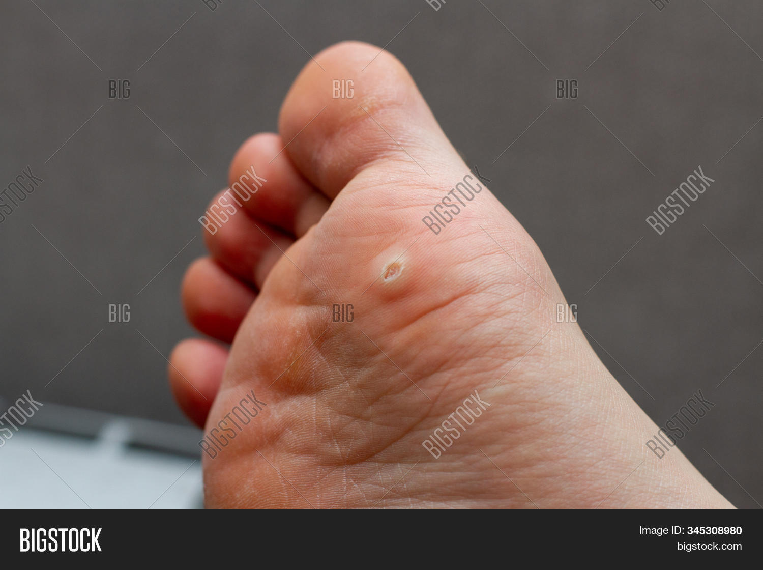 foot,fungal,gesture,health,hpv,human,hygiene,infection,injury,leg,man,medical,medicine,nail,neoplasm,one,pain,papilloma,pedicure,people,person,plantar,shipitsa,showing,skin,thumb,treatment,virus,wart,body,care,caucasian,closeup,concept,corn,diagnosis,disease,doctor,feet,female,finger