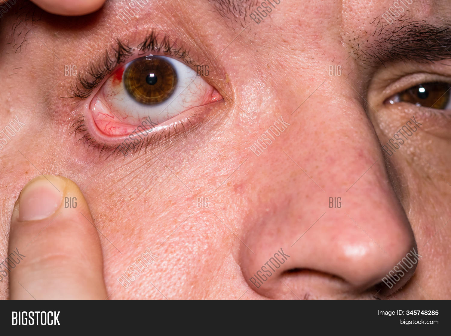 allergy,bleed,blood,bloodshot,brown,eye,bruise,care,caucasian,close,closeup,conjunctiva,conjunctivitis,cornea,damage,up,man,injury,eyeball,eyelash,female,glaucoma,health,hemorrhage,human,infection,inflammation,iris,irritation,macro,medical,medicine,ophthalmology,physical,red,redness,sclera,shot,vessel,white