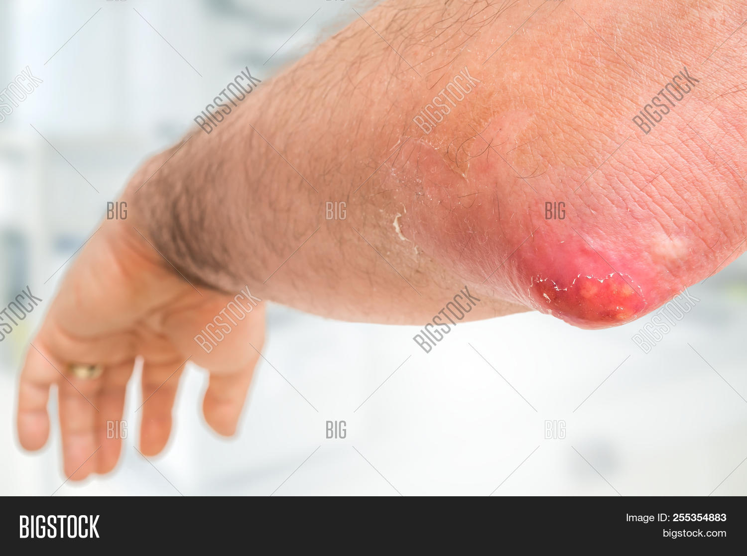 abscess,acne,arm,big,blemish,blister,boil,bump,carbuncle,care,closeup,disease,elbow,excrescence,explode,furuncle,furunculus,hand,health,huge,infection,inflammation,lump,macro,male,man,medical,papula,papule,pimple,problem,pus,pustule,shocked,skin,surgery,whitehead,wound,zit