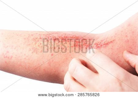 Atopic Dermatitis (ad), Also Known As Atopic Eczema, Is A Type Of ...