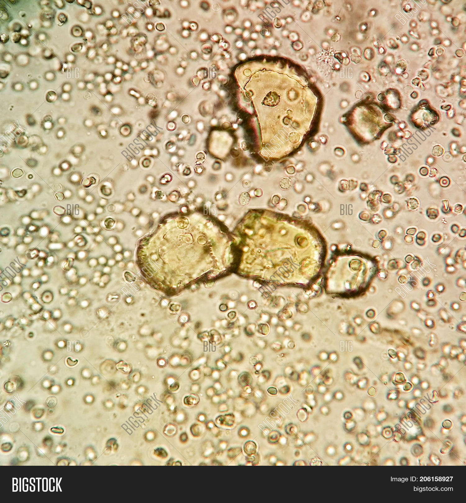Lesch-Nyhan,acid,analysis,area,bleeding,blood,cell,crystal,diagnostic,doctor,drop,erythrocyte,gout,hospital,human,ill,image,infection,kidney,laboratory,leukemia,leukocyte,liquid,medical,microscope,microscopy,nephropathy,nephrotic,pain,painful,pathology,patient,red,salt,sample,sick,small,stone,syndrome,test,triple,uric,urinalysis,urine,yellow