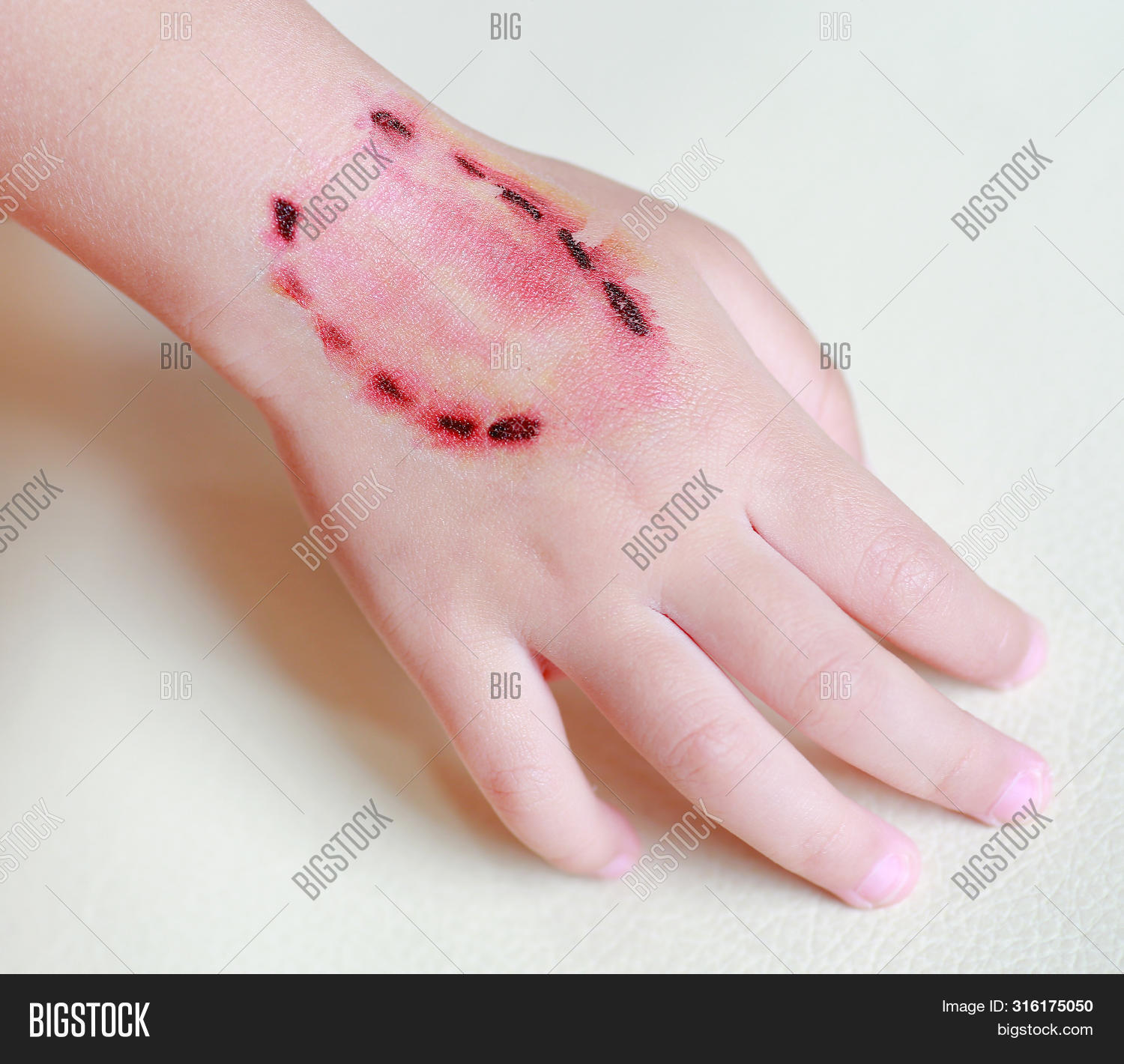 accident,aid,animal,baby,bite,blood,body,bruise,care,child,children,disease,dress,fight,finger,fresh,girl,halloween,hand,health,hospital,human,hurts,illness,injury,lady,lesion,live,medical,medicine,painful,people,prevent,rabies,sad,scratch,sew,skin,stitching,surface,suture,tattoo,teeth,tetanus,trauma,treat,ugly,up,vaccine,wound