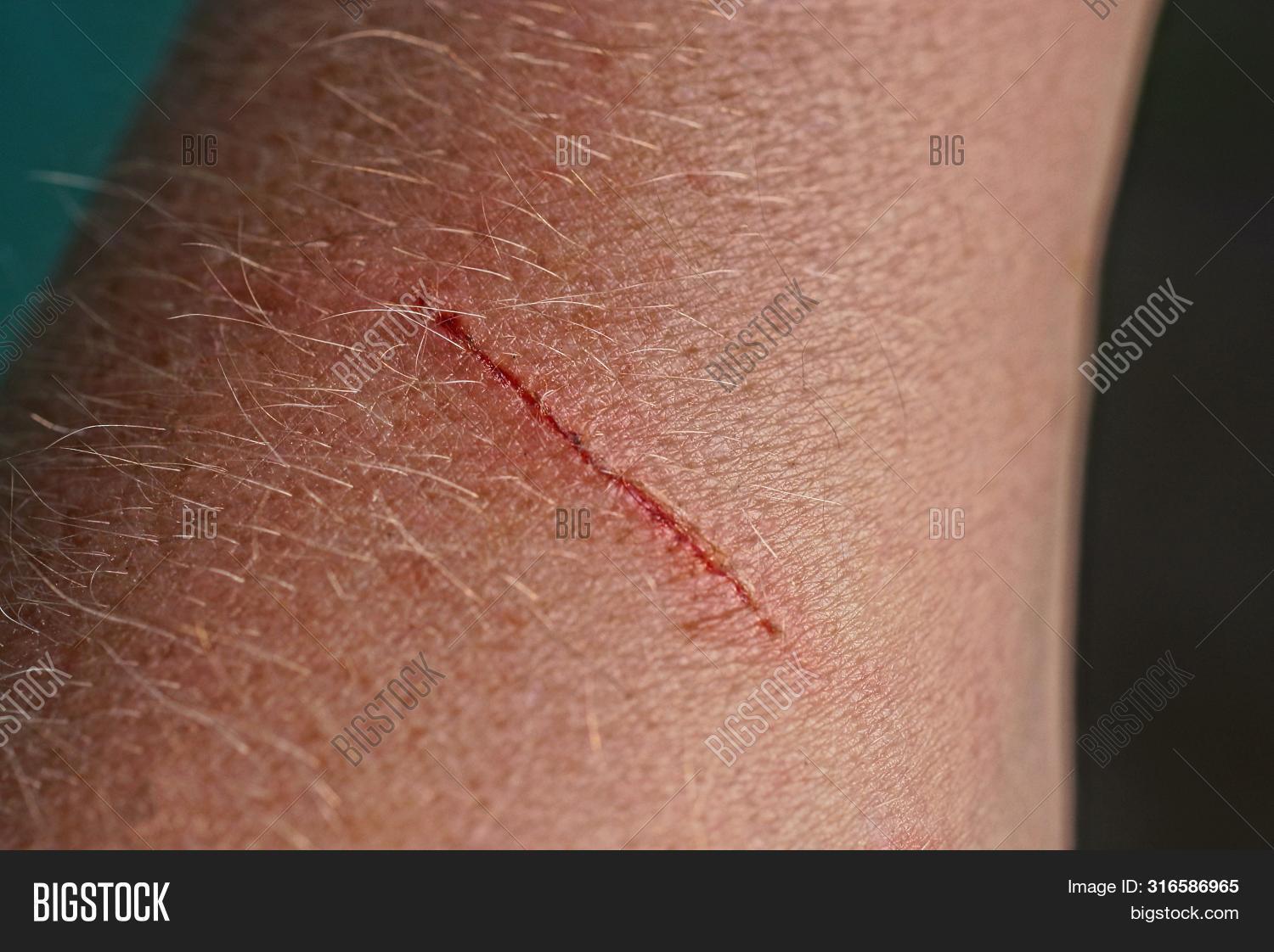 accident,ache,adult,anatomy,arm,bleeding,blood,bloody,body,care,closeup,concept,creative,cut,hand,health,healthy,hospital,human,hygiene,injured,injury,job,lesion,long,macro,maim,man,medical,medication,medicine,muscle,old,patient,people,person,red,rough,scar,scratch,skin,space,therapy,trauma,treatment,white,work,wound,wounded