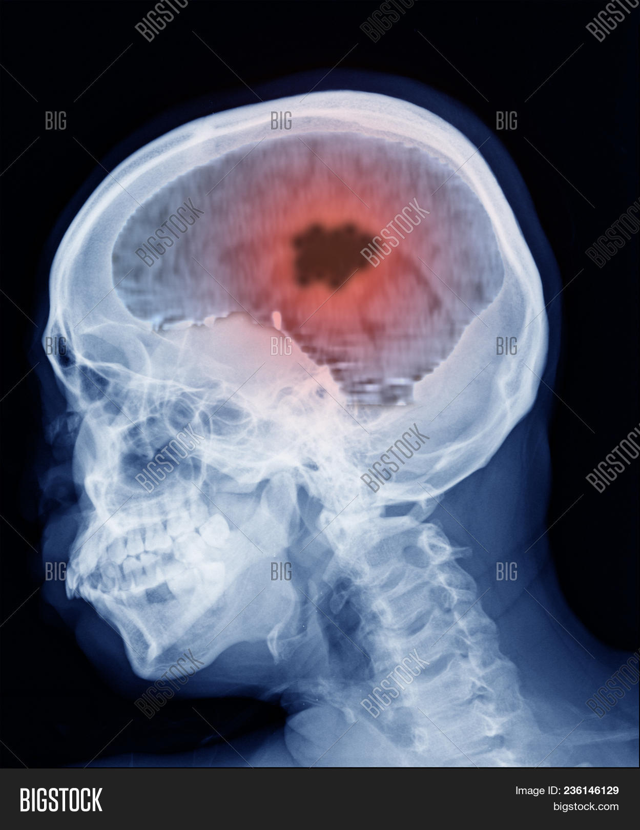 abscess,anatomy,brain,cancer,checkup,computer,ct,diagnose,diagnostic,disease,doctor,examination,film,head,health,healthcare,hemorrhage,hospital,human,image,lab,laboratory,medical,mri,neurologist,neurology,radiation,radiologist,radiology,ray,result,scan,scanning,skull,technology,test,tomography,trauma,treatment,tumor,tumour,x,x-ray