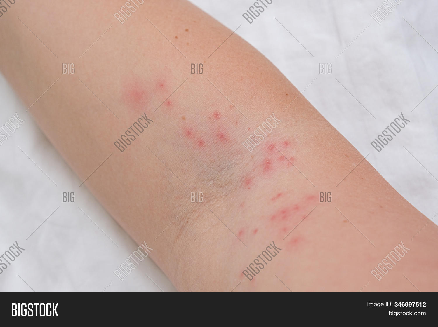 skin,rash,allergy,dermatology,itchy,injury,infection,medical,body,healthcare,dermatitis,health,sore,pink,caucasian,pimple,red,patient,dermatological,arm,epidermis,hand,illness,toxic,disease,reaction,medicine,girl,allergic,condition,closeup,spot,flesh,infect,care,painful,human,pain,dry,detail,peeling,bite,texture,eczema,wound,diagnosis,irritated,allergen,irritation