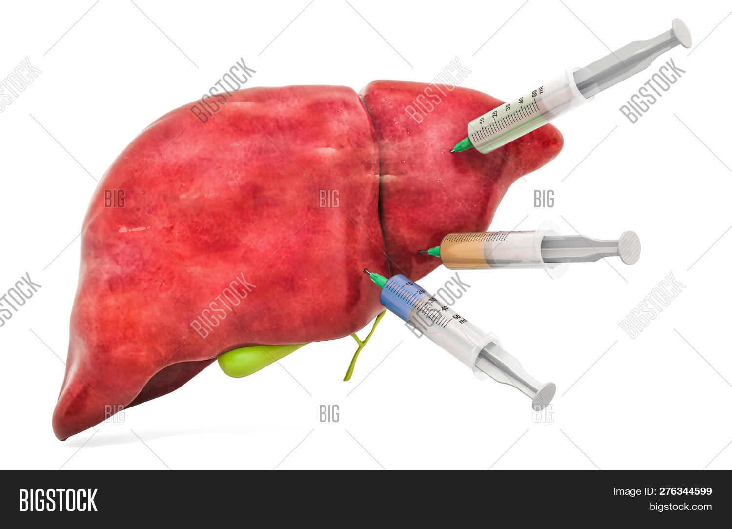 cancer sarcoma tratamento