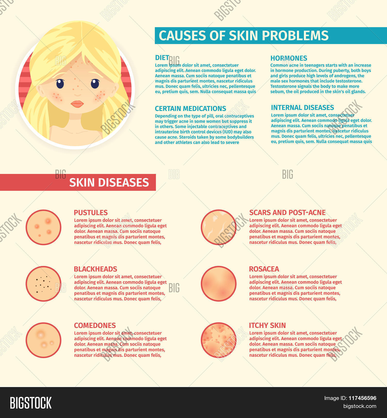 acne,aging,allergy,bacterial,beauty,brochure,cartoon,clean,closeup,concept,cute,dermatology,design,disorders,face,facial,female,girl,head,health,healthy,human,illustration,infographic,irritation,isolated,lady,lesion,macro,model,painful,papules,people,person,pimple,pore,problem,sad,scar,show,skin,skincare,teenager,template,treatment,trouble,ugly,unhealthy,woman,young