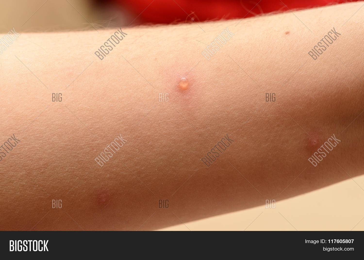 acne,ailing,baby,back,blister,body,chickenpox,child,closeup,contagious,dermatology,disease,disorders,eruption,glands,health,healthcare,herpes,hormone,hygiene,ill,illness,infection,itch,kid,measles,painful,pediatric,pimple,pore,pox,problem,rash,reaction,scratch,sebaceous,shingles,sick,skin,sore,spot,symptoms,teenager,torso,treatment,vaccine,varicella,viral,virus,zoster