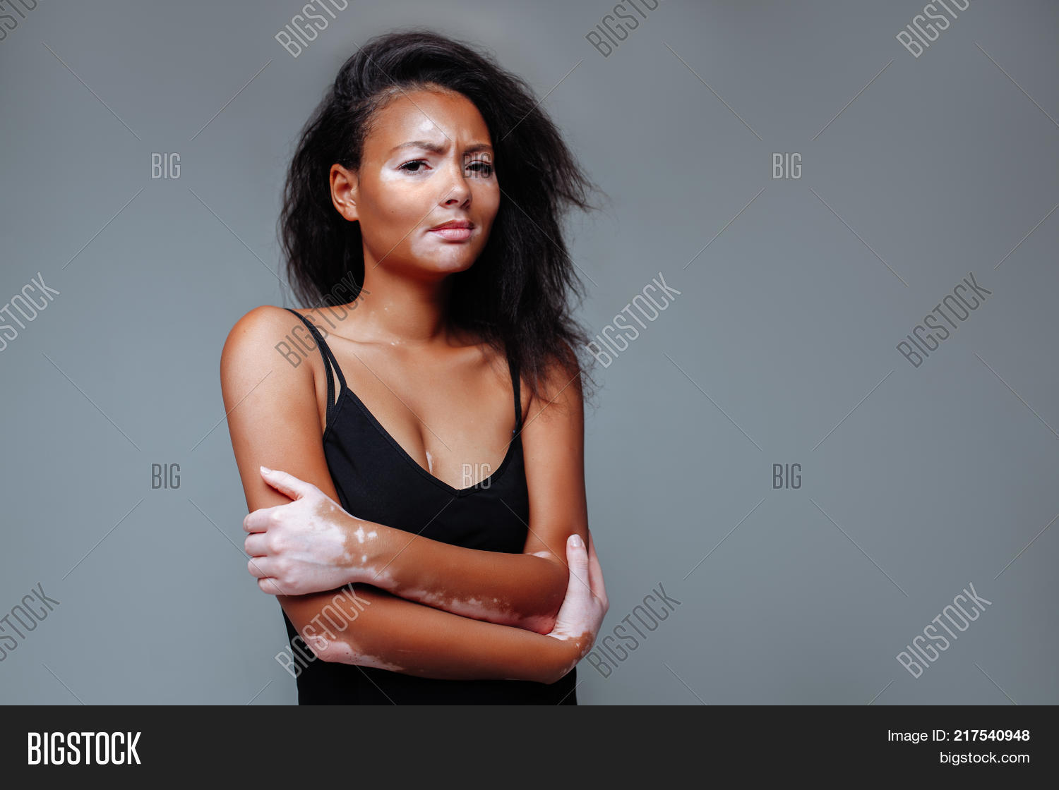 adult,affected,attractive,autoimmune,beautiful,beauty,brunette,care,caucasian,chronic,condition,cosmetic,dark,depigmentation,dermatitis,dermatology,different,disease,disorder,eat,fafrican,fashion,female,food,girl,health,healthcare,healthy,heterochromia,lchocolate,medical,medicine,melanin,melanocytes,normal,pale,patchy,patient,pigment,pigmentation,problem,skin,spot,sweet,tender,treatment,vitiligo,weak,woman,young