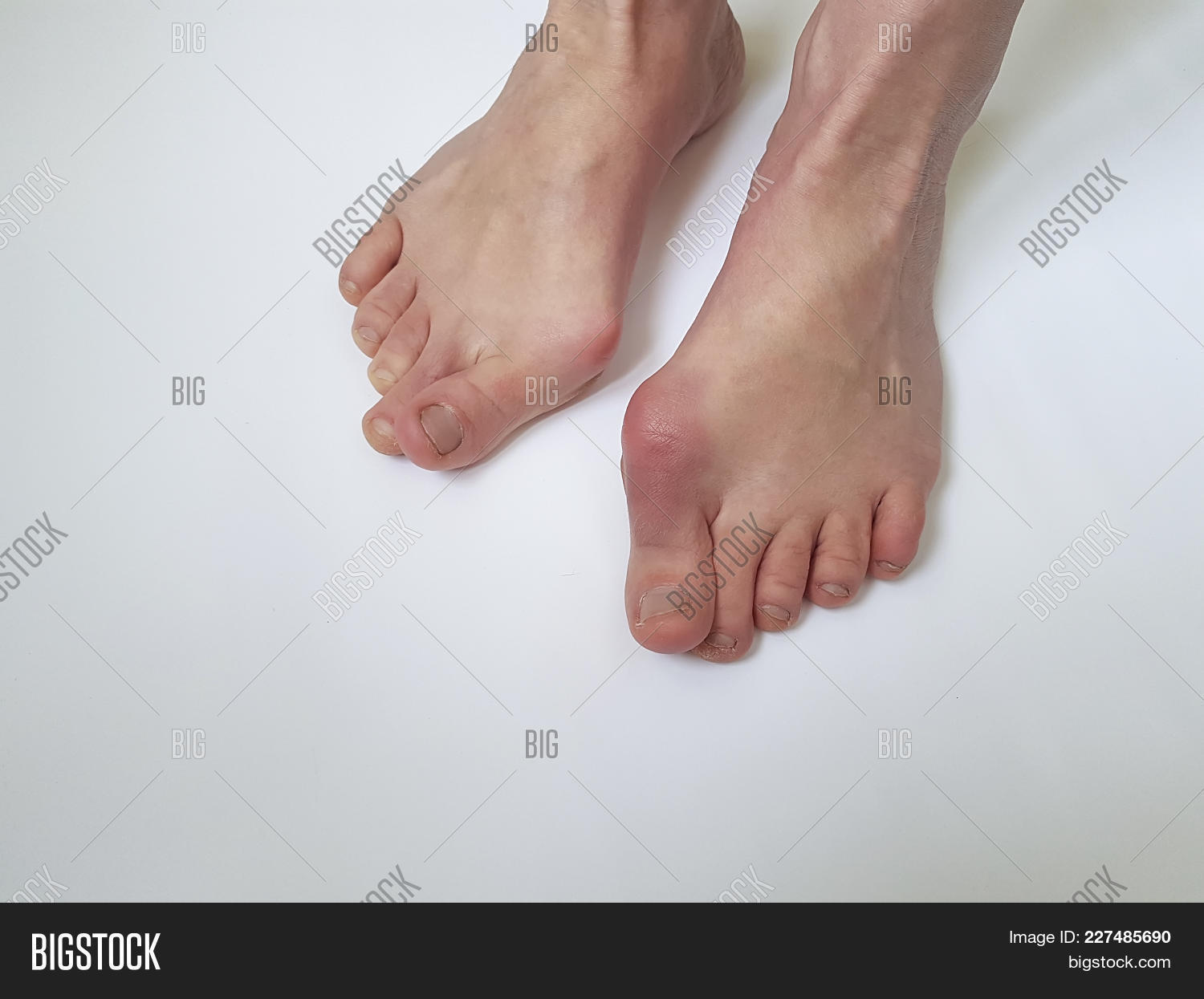 abnormal,adult,anatomy,arthritis,background,bone,bruise,bunion,callus,care,caucasian,chiropractic,closeup,condition,deformation,deformed,deformity,deviation,disease,feet,female,finger,foot,hallux,health,human,hurt,illness,inflammation,injury,leg,medical,medicine,misalignment,nail,orthopedic,pain,painful,patient,phalangeal,physical,podiatric,problem,sprain,swollen,tissue,treatment,valgus,white,woman