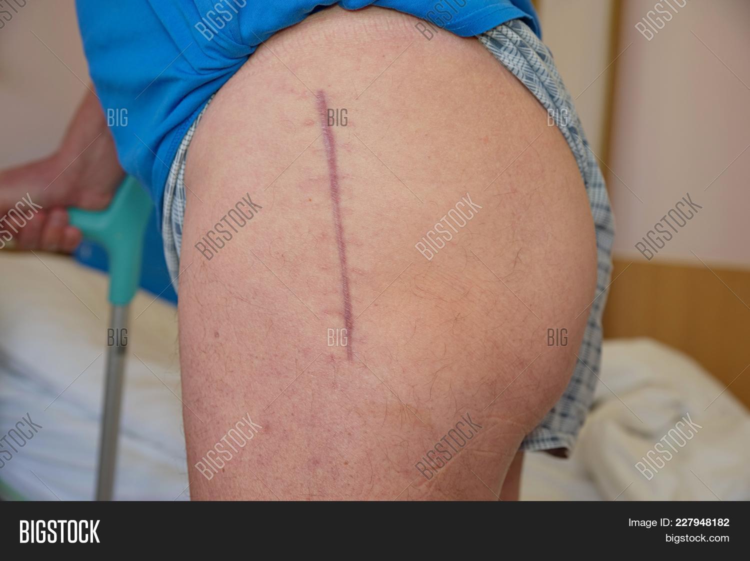 acetabulum,affected,and,arthritis,artificial,bed,body,bone,care,component,crutch,crutches,department,devastated,disinfection,endoprosthesis,femur,forearm,healing,health,healthy,hip,hospital,iliac,incision,injury,inpatient,joint,laceration,leg,man,medical,medicine,mending,metal,naked,pain,patient,pelvic,pelvis,person,plastic,procedure,rheumatoid,scab,scar,skin,stitch,surgery,surgical