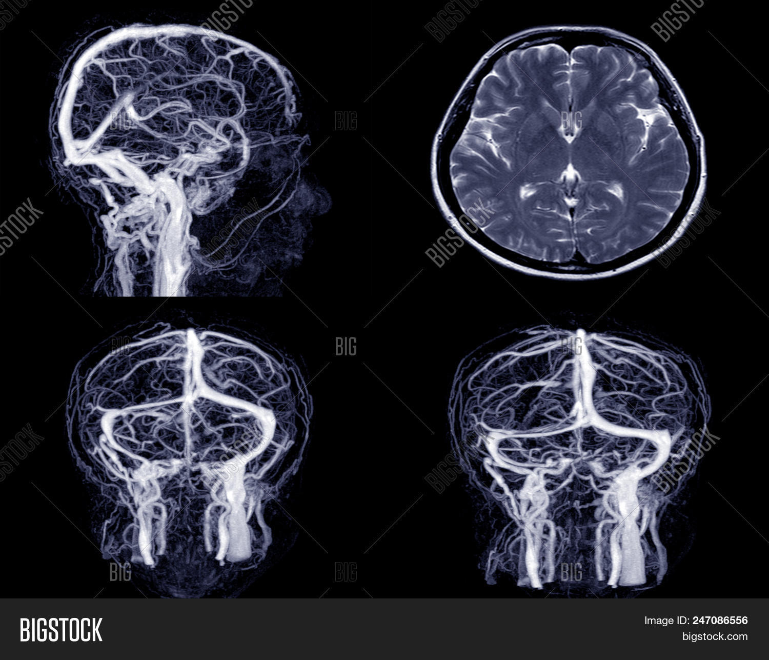 anatomy,aneurysm,angiogram,angiography,artery,body,bones,brain,cancer,cell,ct,cta,diagnosis,diagnostic,disease,film,head,headache,health,healthcare,hospital,human,illness,image,imaging,injury,magnetic,medical,medicine,mra,neurons,neurosurgery,patient,people,person,radiology,resonance,scan,science,sick,skeleton,stroke,surgery,technology,test,tomography,treatment,tumor,xray