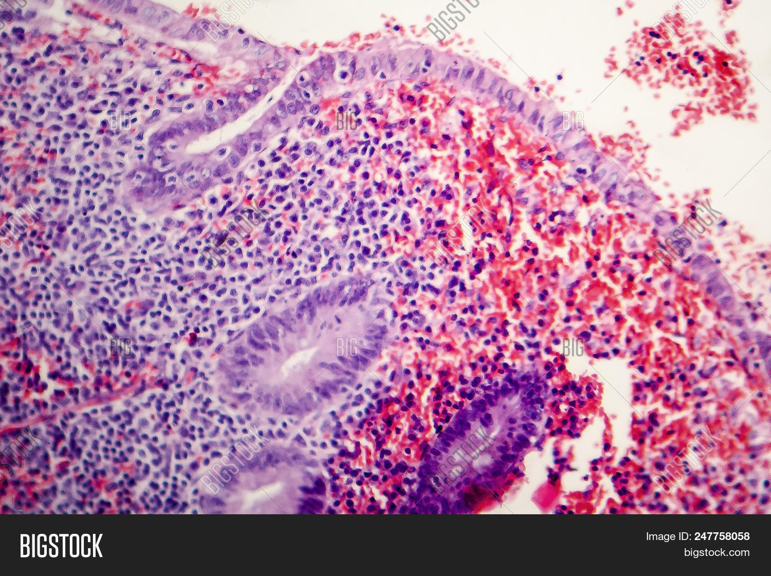 Histopathology of chronic appendicitis, light micrograph, photo under ...