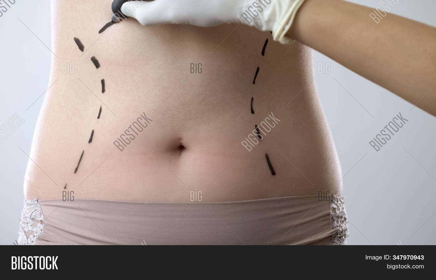 abdomen,abdominal,abdominoplasty,aesthetic,aging,arrows,beauty,belly,body,cellulite,clinic,close,close-up,closeup,correcting,correction,cosmetic,diet,draw,drawing,excess,fat,female,lady,laser,line,liposuction,manual,mark,operation,patient,plastic,prepare,preparing,procedure,reconstructive,rejuvenate,skin,stomach,surgeon,surgery,torso,trace,tucks,tummy,up,waist,weight,woman,young