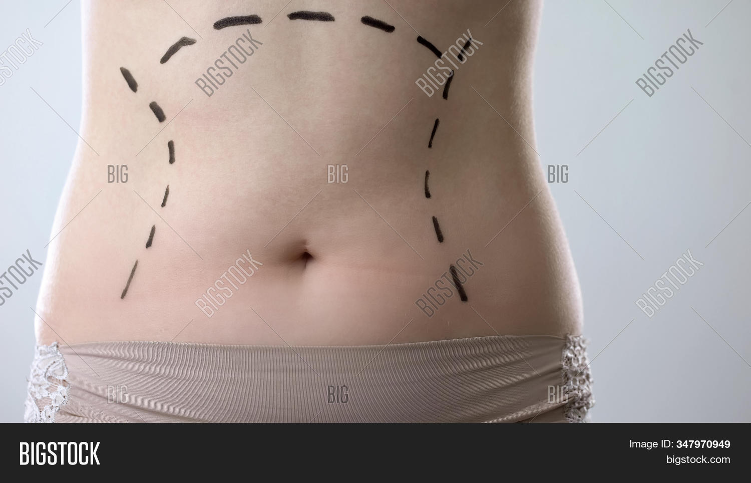 abdomen,abdominal,abdominoplasty,aesthetic,aging,arrows,beauty,belly,body,cellulite,clinic,close,close-up,closeup,correcting,correction,cosmetic,diet,draw,drawing,excess,fat,female,lady,laser,line,liposuction,manual,mark,operation,patient,plastic,prepare,preparing,procedure,reconstructive,rejuvenate,skin,stomach,surgeon,surgery,torso,trace,tucks,tummy,up,waist,weight,woman,young