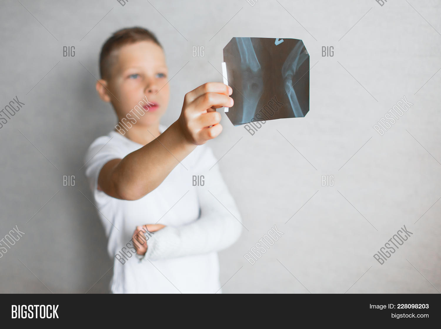 The Boy With A Broken Hand Looks At The Xray. Xray In The Hands Of A