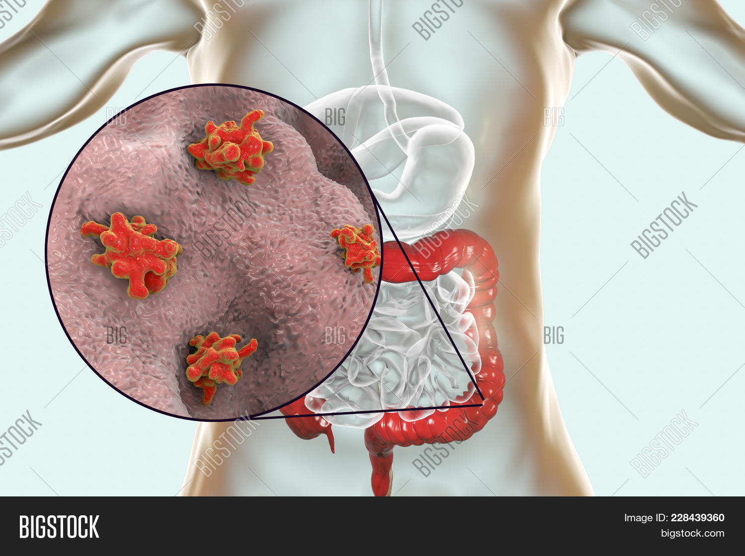 3d,Acanthamoeba,aggression,ameba,amebiasis,amoeba,amoebic,anatomy,bacteria,biology,capturing,cell,coli,colon,disease,dysentery,entamoeba,eukaryote,gingivalis,gut,healthcare,histolytica,illness,illustration,infection,intestine,invasion,large,macro,medical,medicine,microbe,microbiology,microscopic,organic,organism,parasite,parasitic,proteus,protozoan,pseudopodia,research,science,scientific,sickness,sigmoid,testate,unicellular
