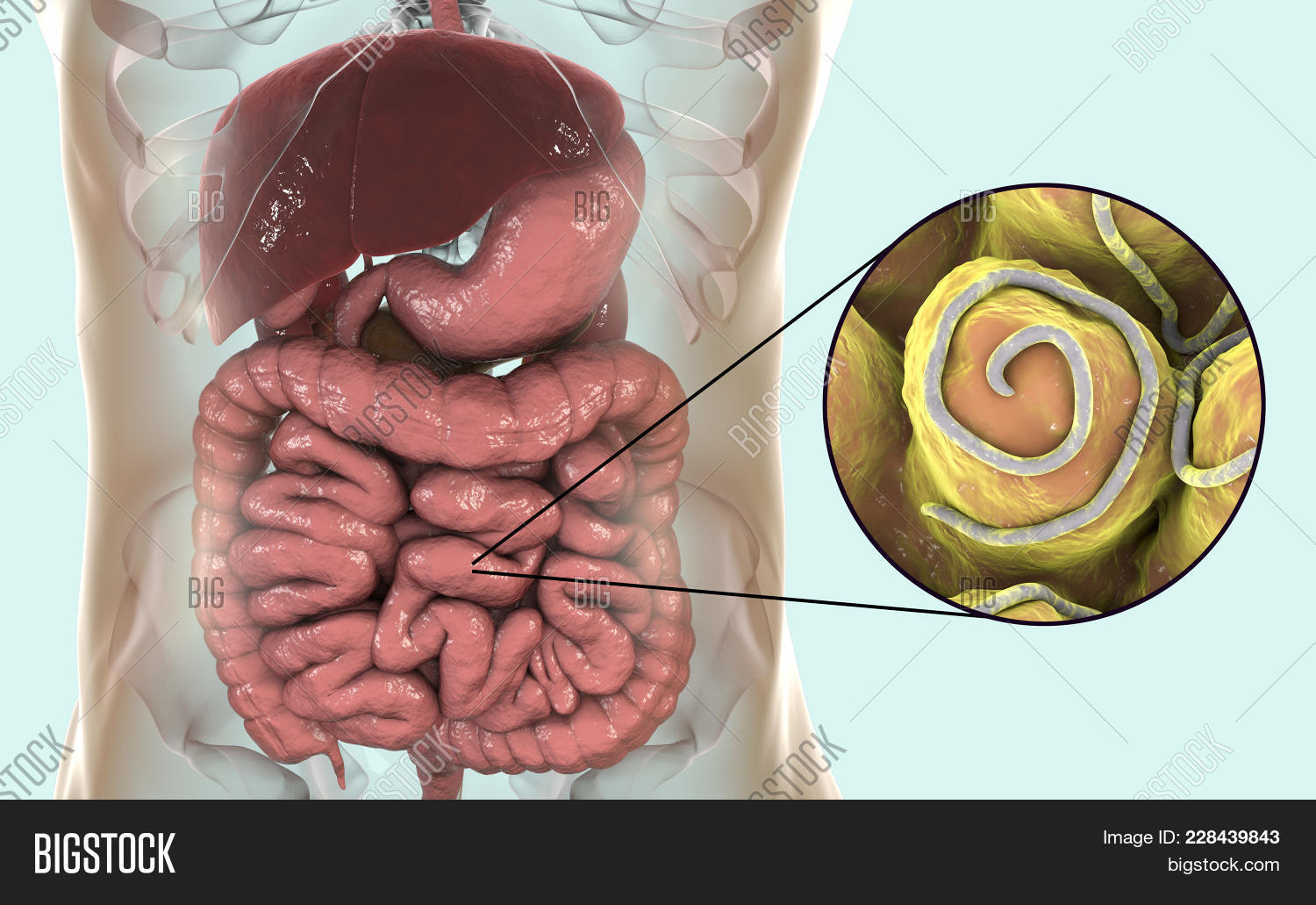 Helminths Nematodes Enterobius In The Gut. Threadworm Which Causes ...