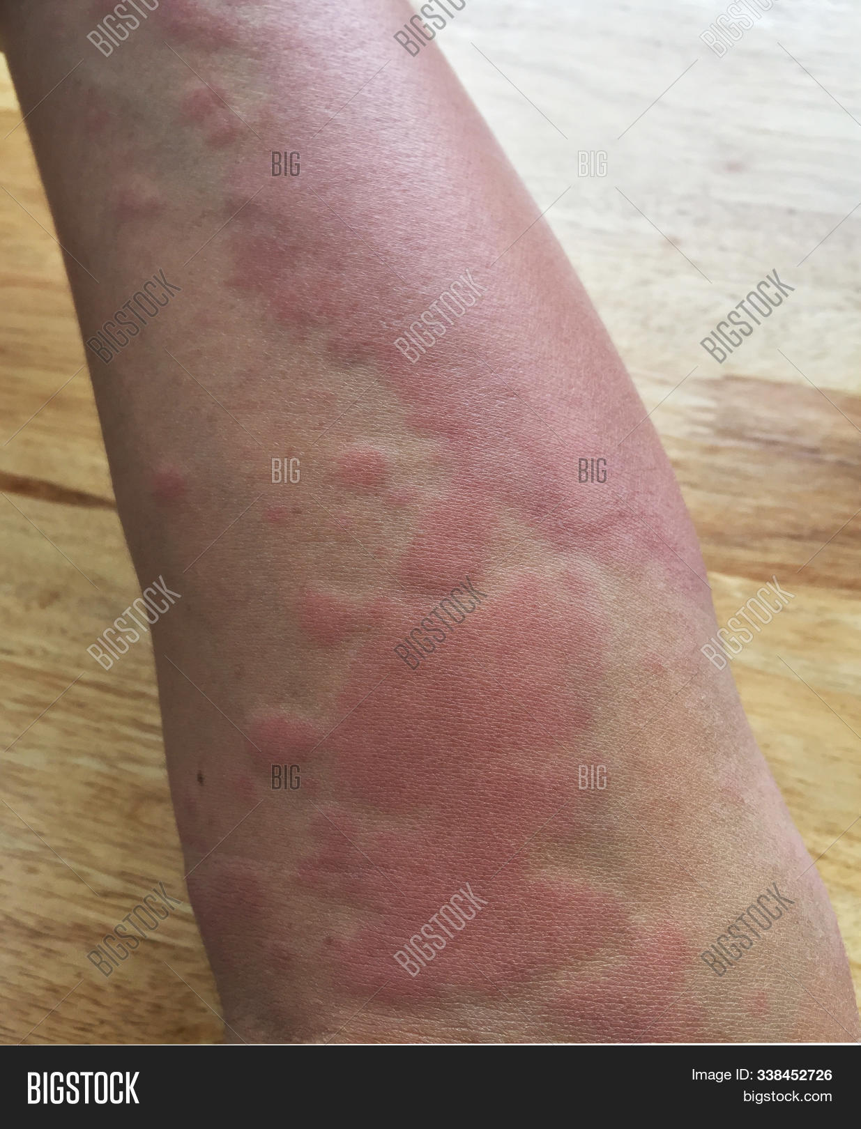 allergic,allergy,bee,body,care,caucasian,center,clinic,close-up,closeup,concept,disease,eczema,eyes,face,health,hives,hospital,human,illness,infirmary,inflammation,itch,itchy,medical,medicine,pain,problem,puffy,rash,reaction,red,redness,room,seniors,sick,skin,sting,swollen,symptoms,tired,urgency,urticaria,waiting,woman,wrinkles