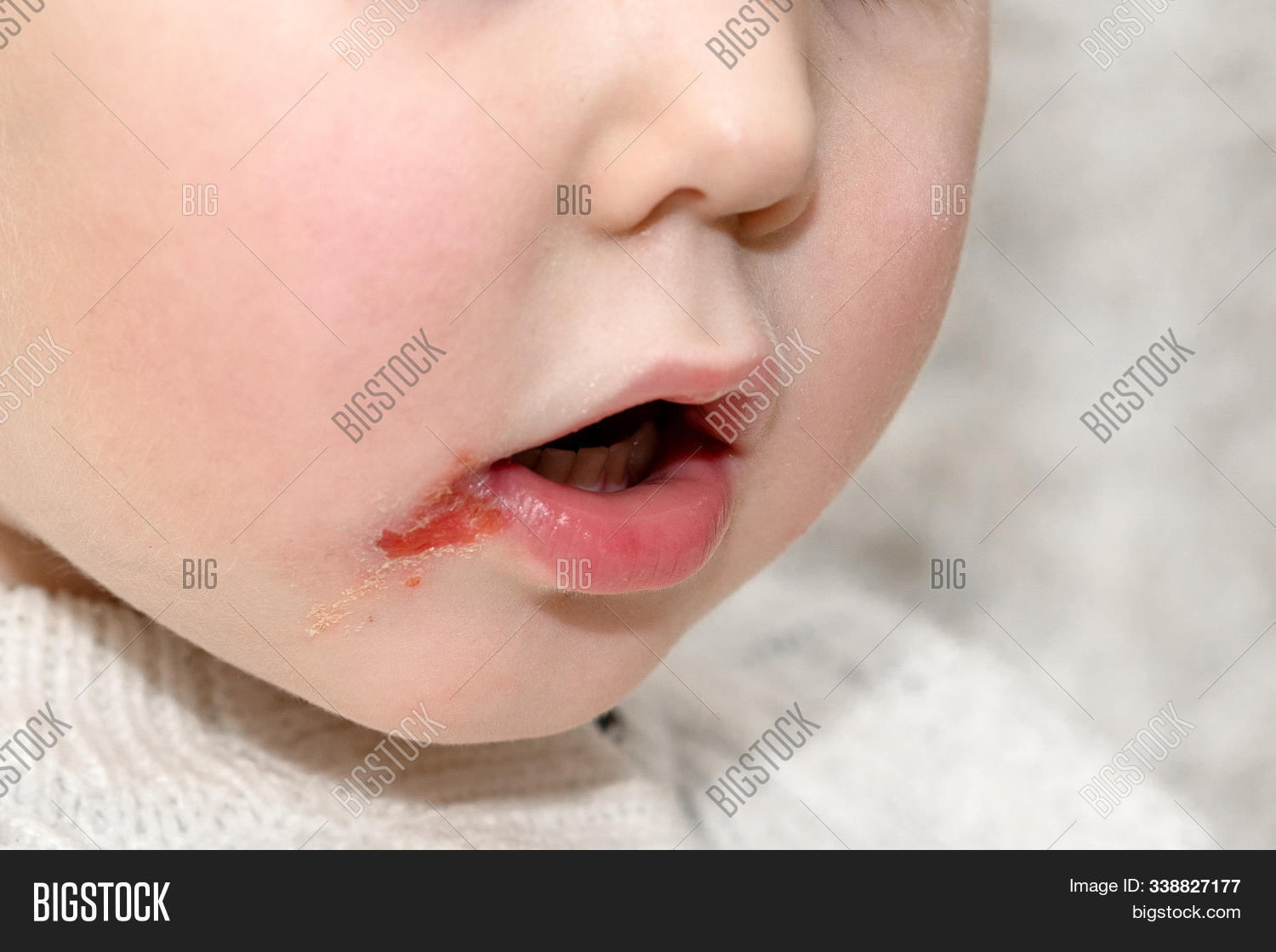 Chap Face Herpes On Upper Lip Of A Little Girl. Wound On The Face Of A Schoolboy ...