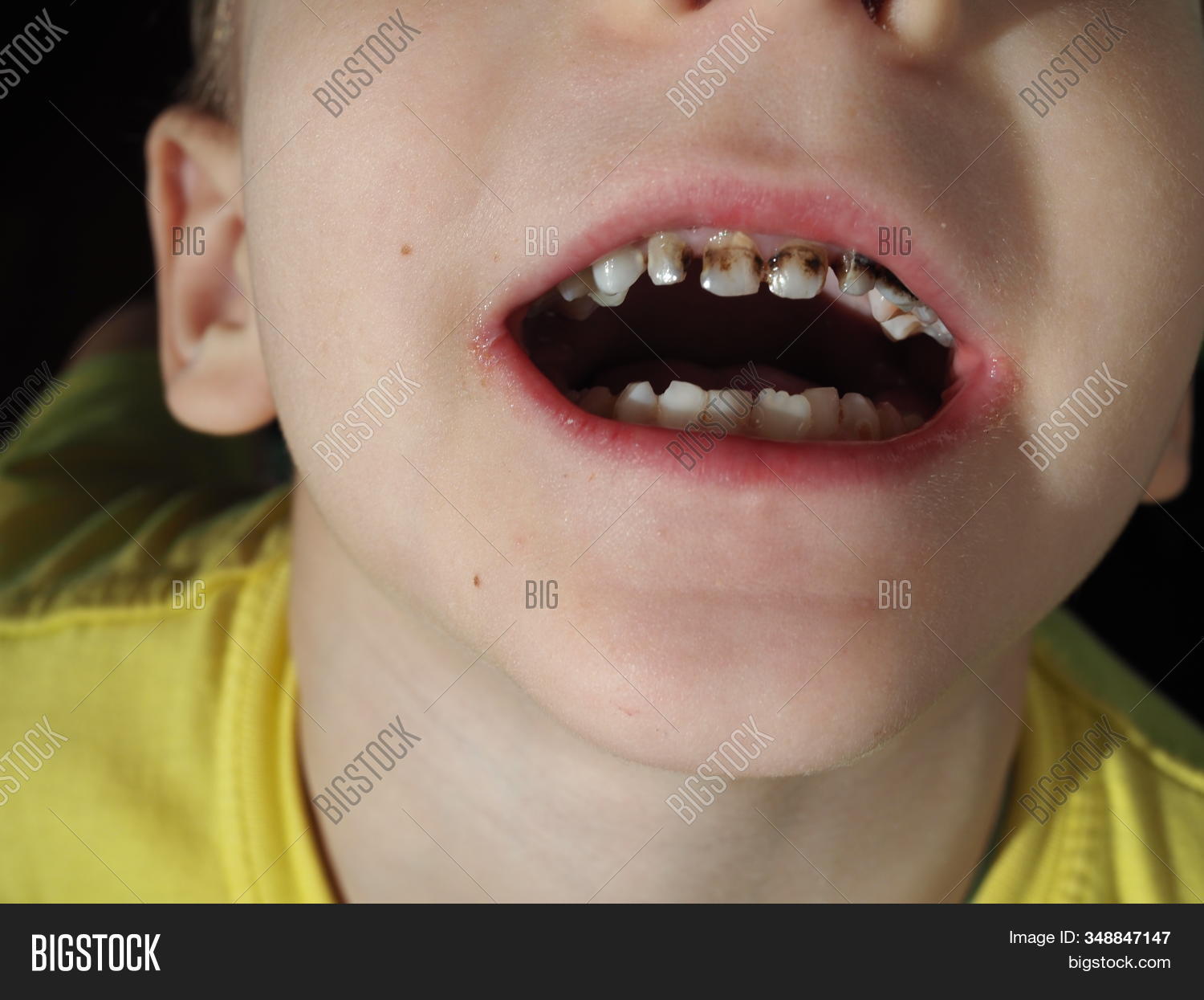 tooth,boy,abnormal,teeth,mouth,strange,orthodontist,patient,health,oral,problem,medical,healthy,diagnosis,dentist,dental,tongue-tie,treatment,teething,stomatology,throat,trouble,odd,toothy,spacing,missing,bad,braces,closeup,curve,dentistry,disease,lips,molar,medicine,sick,medication,hygiene,repair,periodontal,clinic,child,background,stick,kid,illness,gums,ankyloglossia