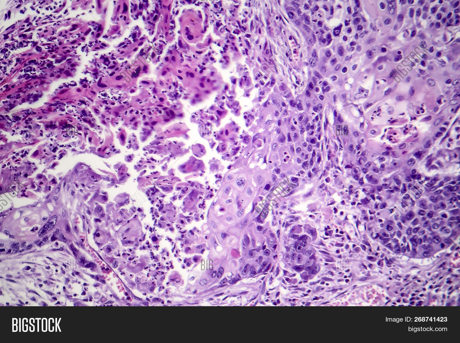 Squamous Cell Carcinoma Of The Lung, Light Micrograph, Photo Under ...