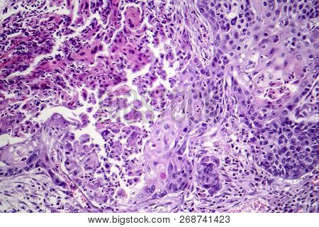 Squamous Cell Carcinoma Of The Lung, Light Micrograph, Photo Under ...