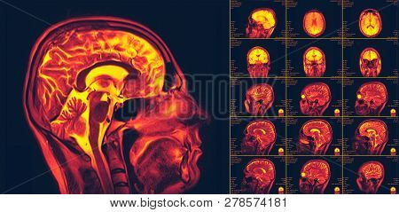 Magnetic Resonance Imaging Of The Brain. Mri Scan image & stock photo ...