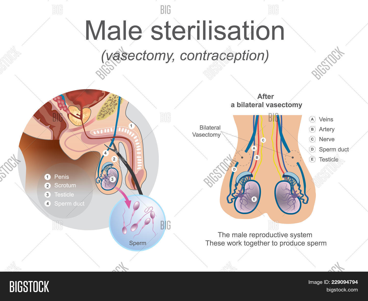 Male,artery,baby,bilateral,birth,bladder,block,breed,care,condom,correct,cut,diabetes,dysfunction,egg,female,fuck,give,gland,graphic.,healthy,heart,illustration,info,insert,masculine,meet,mom,natural,nerve,penis,process,reproductive,scrotum,sexual,sperm,sterilisation,surgery,testicle,together,urine,vasectomy,veins,work,zinc