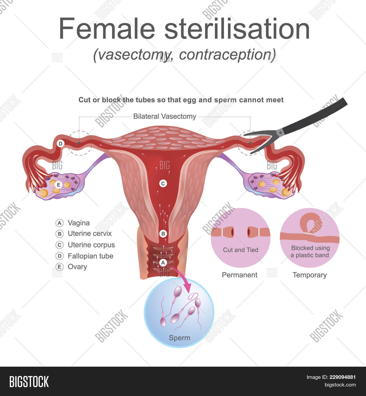 anatomy,artery,baby,bilateral,birth,bladder,block,body,breed,care,cervix,correct,cut,diabetes,dysfunction,egg,fallopian,female,give,gland,graphic,health,heart,human,illustration,info,insert,masculine,medical,meet,mom,natural,nerve,ovary,penis,permanent,process,reproductive,sexual,sperm,sterilisation,surgery,temporary,together,urine,vagina,vasectomy,veins,work,zinc
