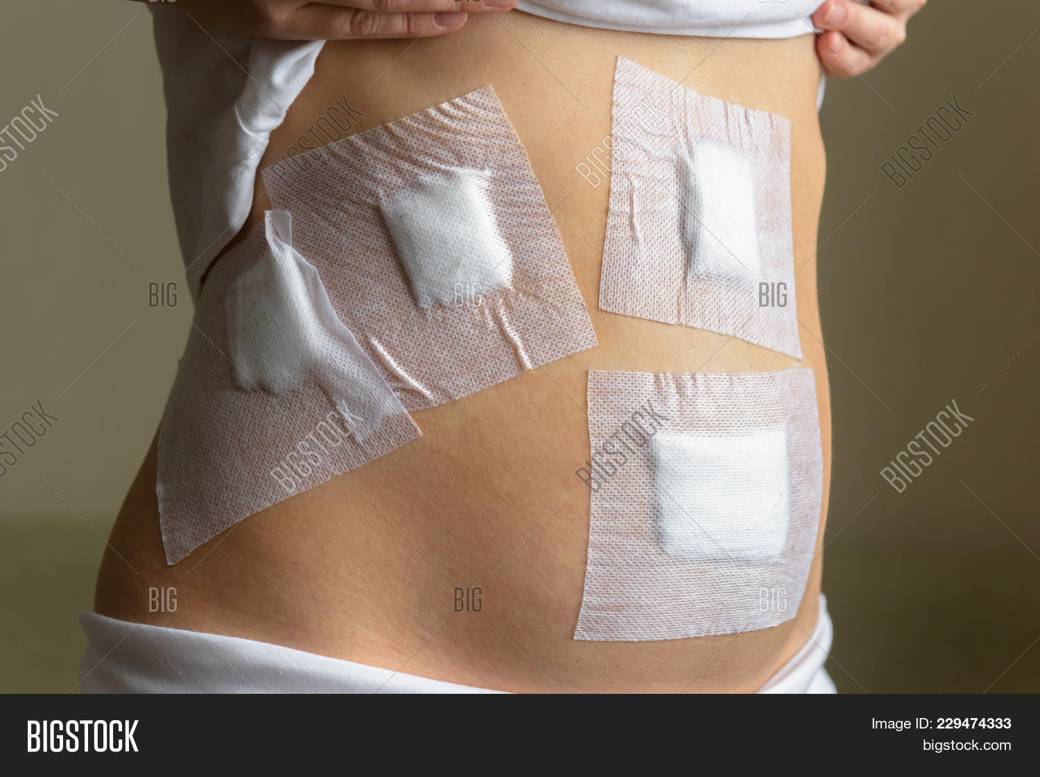 abdomen,abdominal,adult,bandage,bandaging,belly,body,caucasian,cholecystitis,cholelithiasis,clinic,disease,dressing,endoscopy,female,gallbladder,gauze,healthcare,hospital,human,laparoscopy,medical,medicine,myoma,naked,operating,operation,patient,plaster,postoperative,postsurgical,recovery,remove,skin,surgery,surgical,torso,waist,white,woman,wound,young
