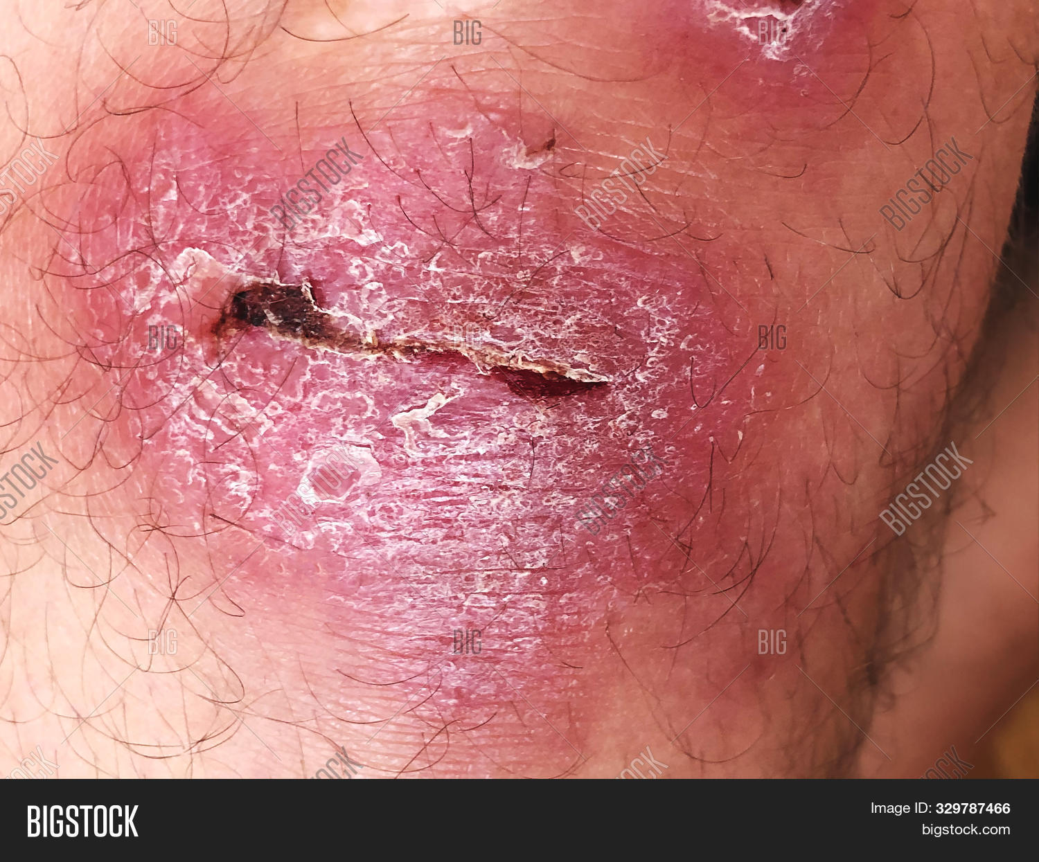 abrasion,accident,ache,adult,aid,arm,asian,back,background,bleeding,blood,body,caucasian,closeup,damage,dirt,drop,fell,flow,heal,health,help,human,hurt,hygiene,injured,injury,kid,knee,leg,male,man,medical,medicine,pain,painful,patient,people,person,red,scrape,scratch,skin,sport,tear,tribe,wet,wound