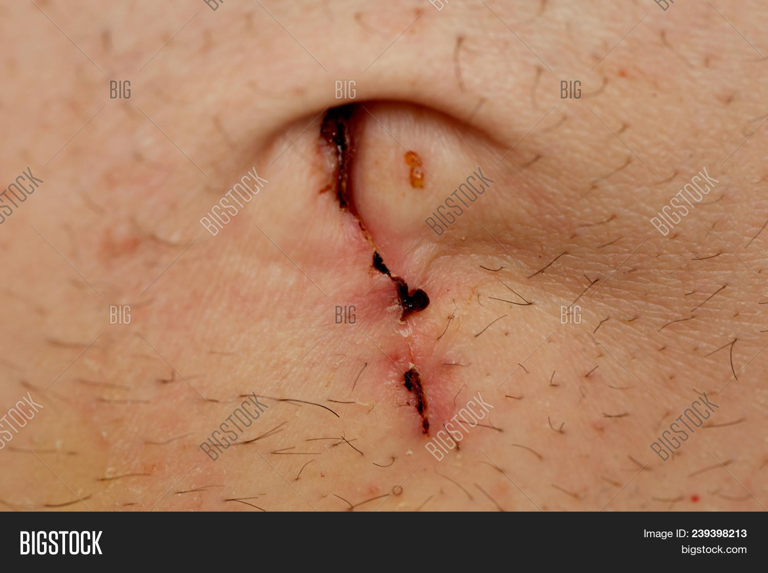 1,abdomen,abdominal,ache,anatomy,appendectomy,appendicitis,appendix,background,belly,body,button,care,caucasian,cut,disease,emergency,hair,heal,health,healthcare,hospital,human,illness,incision,injury,keyhole,male,man,medical,medicine,one,operation,pain,painful,person,removal,scar,shaven,sick,skin,stitches,stomach,surgery,suture,treatment,tummy,urgency,white,wound