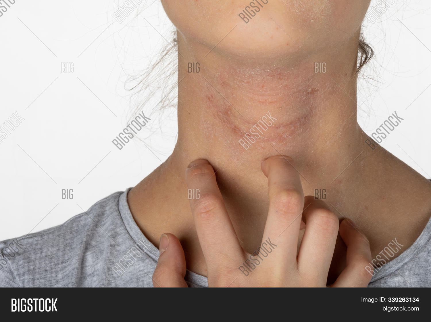 allergic,allergy,atopic,care,caucasian,closeup,concept,cosmetic,cute,dermatitis,dermatology,dry,eczema,epidermis,female,finger,food,girl,hand,health,healthcare,healthy,hives,hygiene,illness,irritation,itch,itchy,medical,medicine,natural,neck,people,person,pollen,problem,rash,reaction,scratch,sick,sickness,skin,skincare,symptom,teen,treatment,unwell,white,young